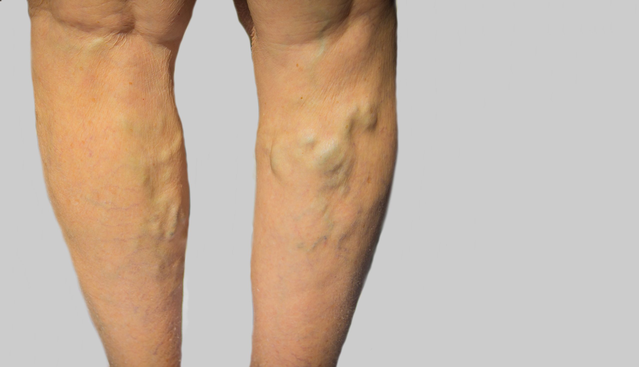 Reclaim Your Confidence with Spider Vein Treatment in Mercer County, NJ