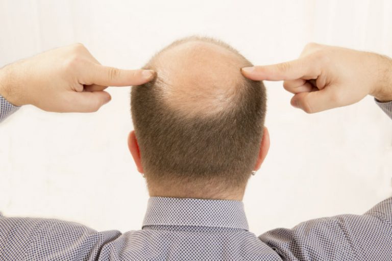 Receive a Professional Hair Transplant in Connecticut To Cover Bald Areas