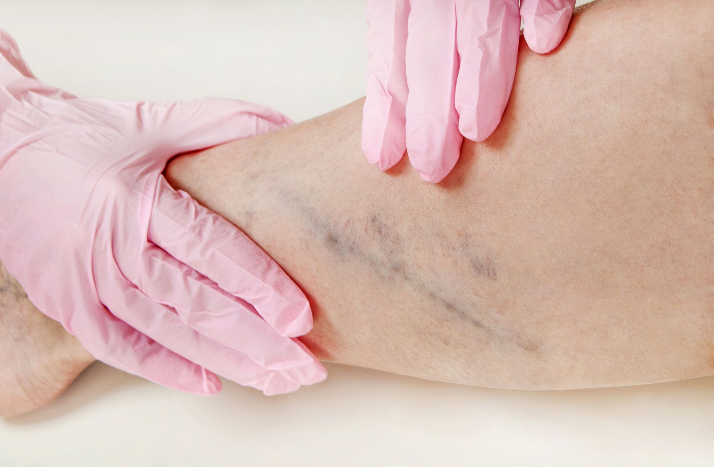 When to Seek Varicose Vein Treatment in Bucks County, PA