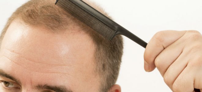 Determining If You Are a Good Candidate for Hair Transplants in Mclean, VA